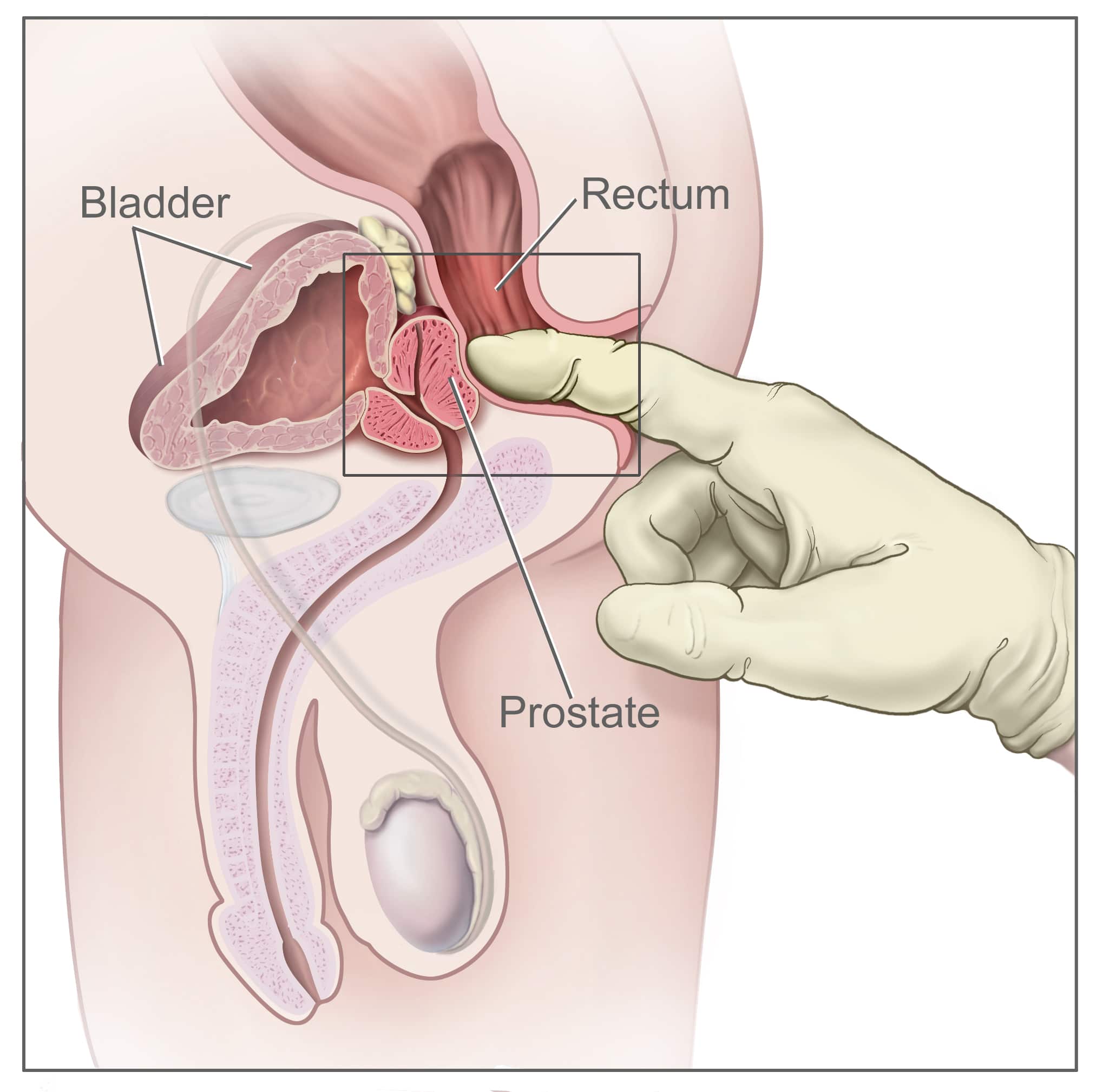 prostata guide 